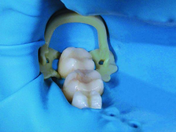 Soft Clamp General Kit 5250